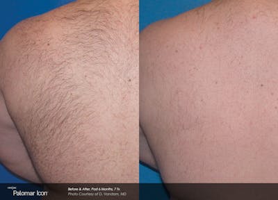 Laser Hair Removal Before & After Gallery - Patient 180415500 - Image 1