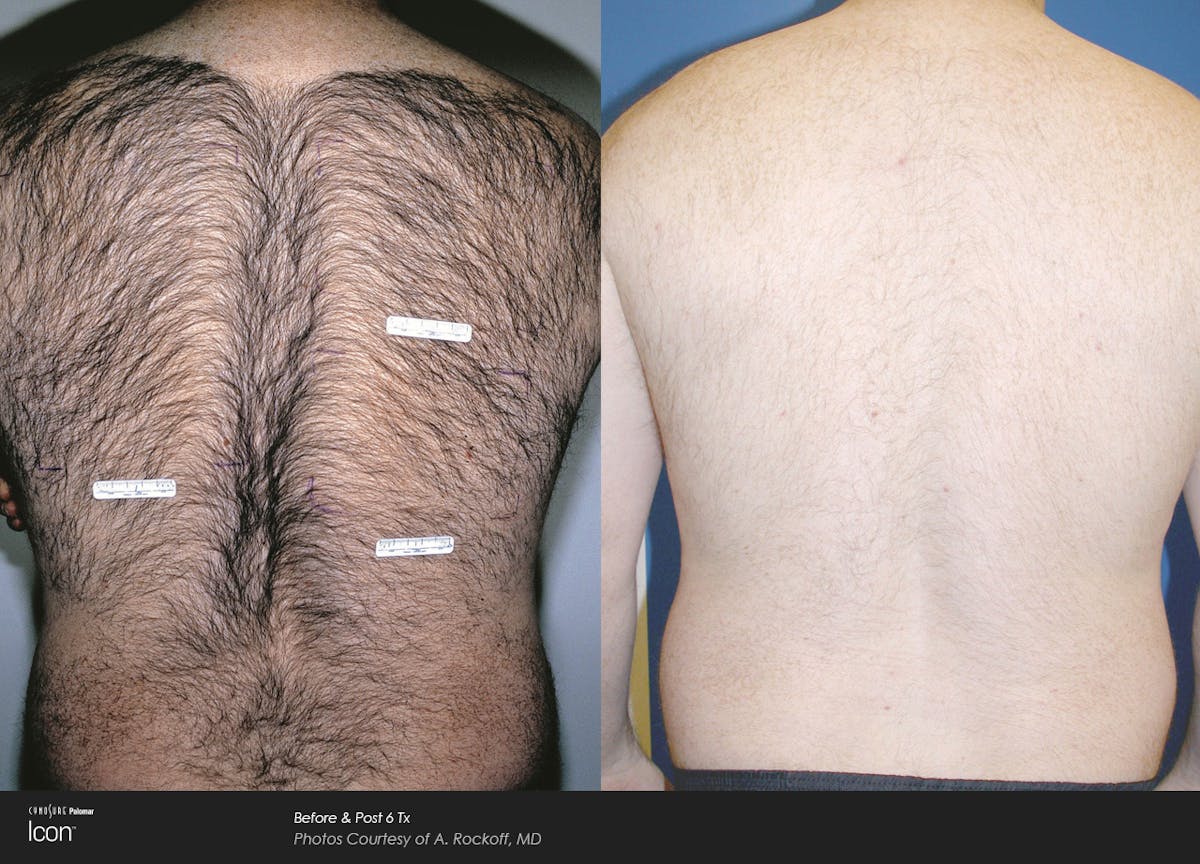 Laser Hair Removal Before & After Gallery - Patient 180415501 - Image 1