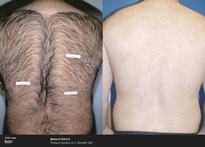 Laser Hair Removal Before & After Gallery - Patient 180415501 - Image 1