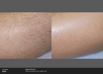 Laser Hair Removal Before & After Gallery - Patient 180415502 - Image 1