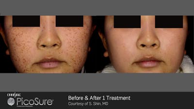 PicoSure Before & After Gallery - Patient 180415508 - Image 1