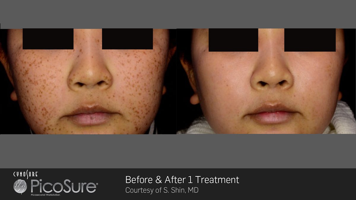 PicoSure Before & After Gallery - Patient 180415508 - Image 1
