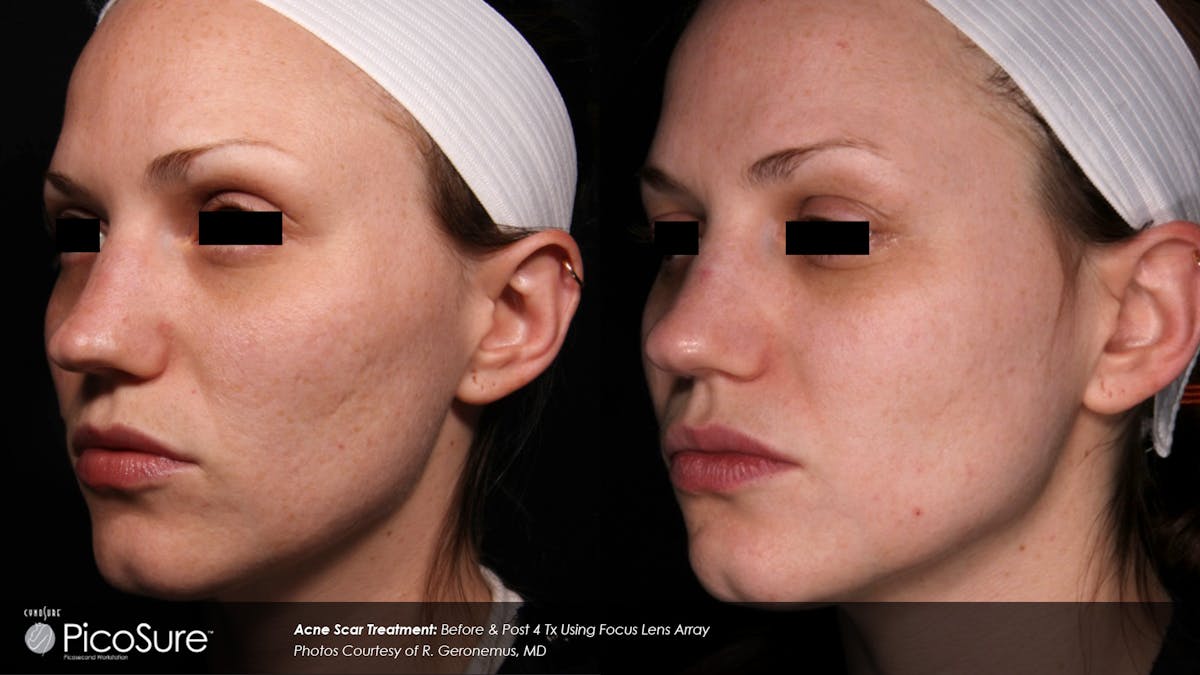 PicoSure Before & After Gallery - Patient 180415509 - Image 1