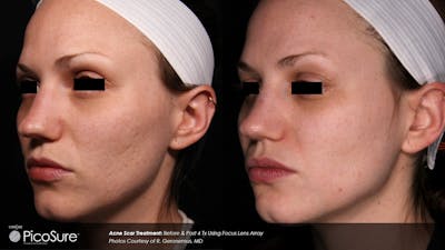 PicoSure Before & After Gallery - Patient 180415509 - Image 1