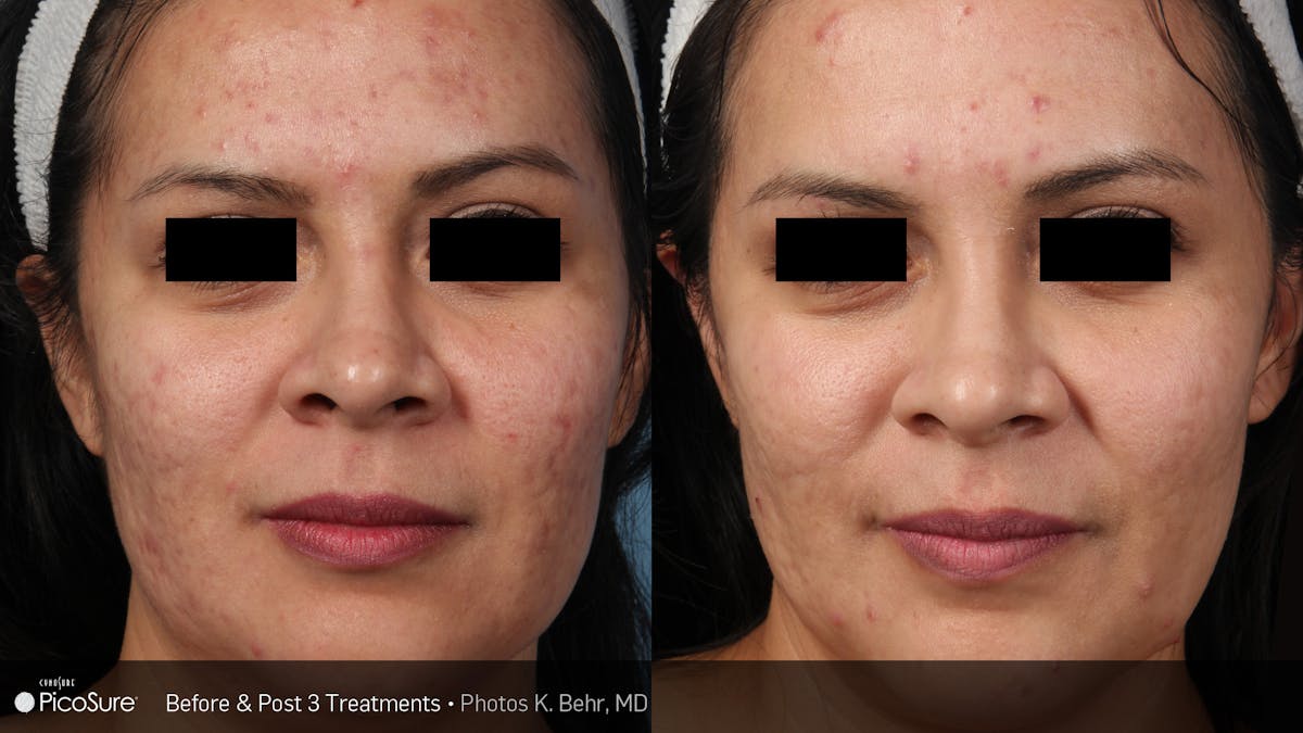 PicoSure Before & After Gallery - Patient 180415510 - Image 1