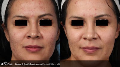 PicoSure Before & After Gallery - Patient 180415510 - Image 1