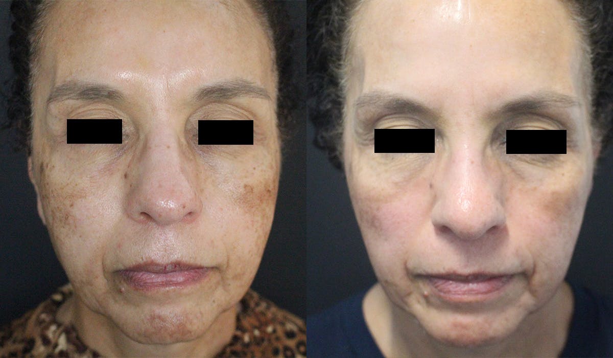 PicoSure Before & After Gallery - Patient 428661 - Image 1