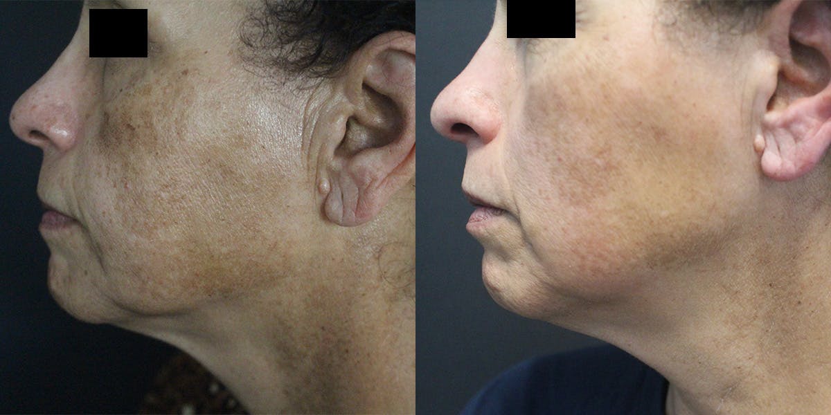 PicoSure Before & After Gallery - Patient 428661 - Image 2