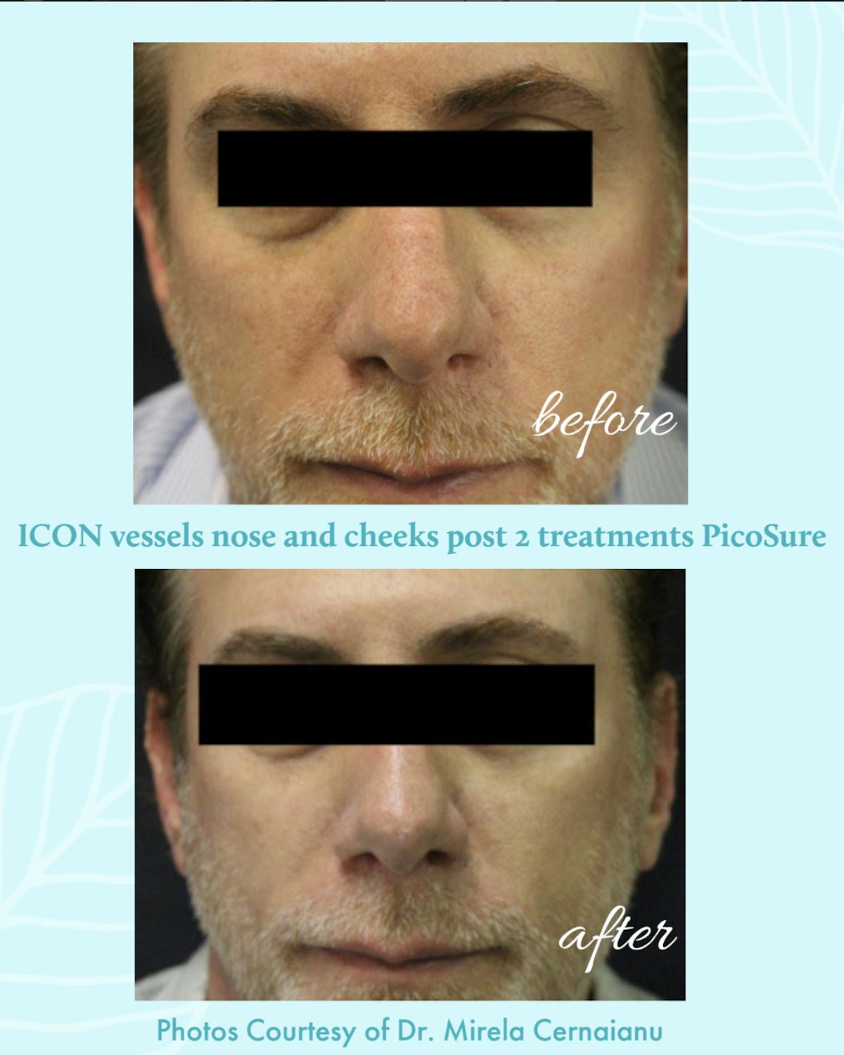 PicoSure Before & After Gallery - Patient 514841 - Image 1