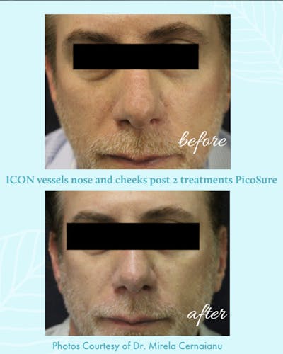 ICON™ Before & After Gallery - Patient 152242 - Image 1