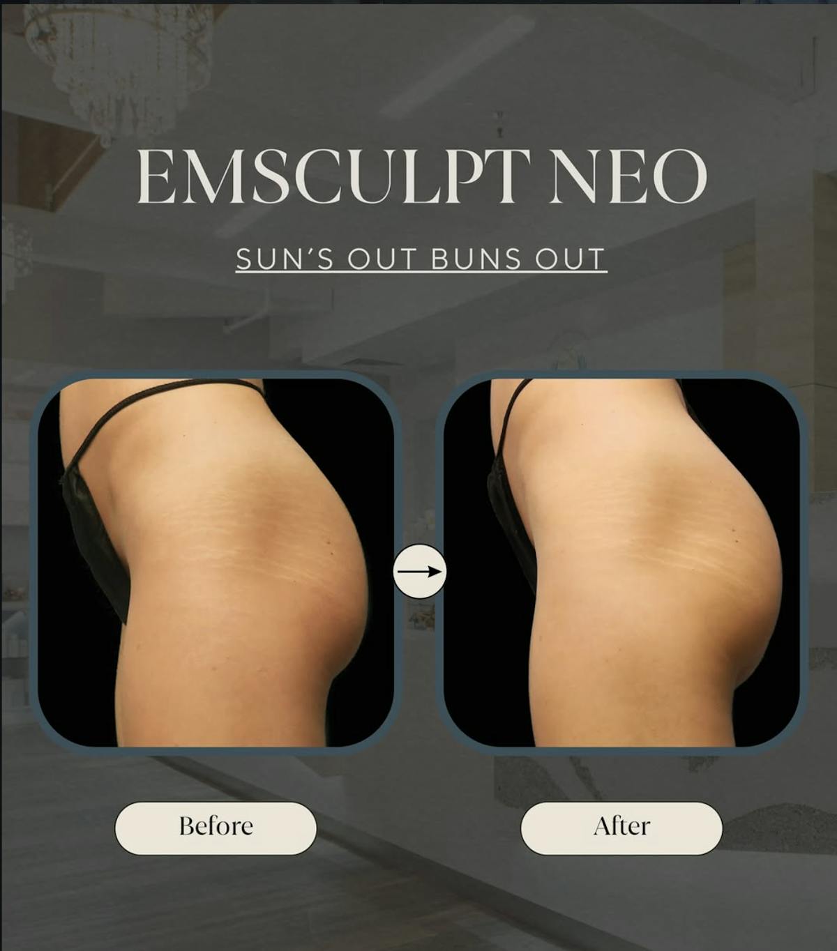 EmSculpt NEO Before & After Gallery - Patient 107748 - Image 1