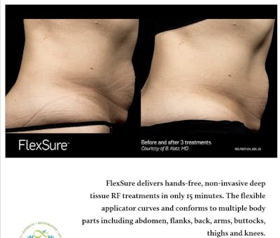 FlexSure Before & After Gallery - Patient 186905 - Image 1