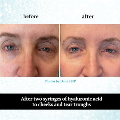 Tear Trough Fillers Before & After Gallery - Patient 296043 - Image 1