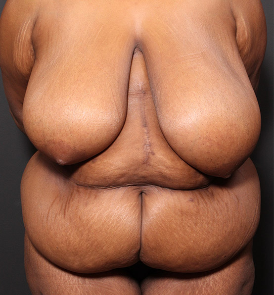 Plus sized tummy tuck patient