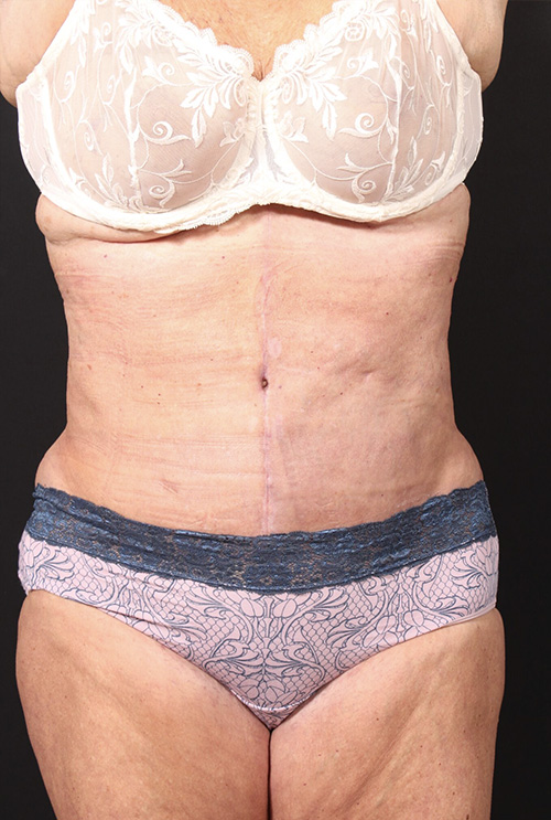 Plus sized tummy tuck patient