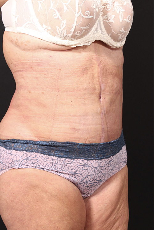 Plus sized tummy tuck patient