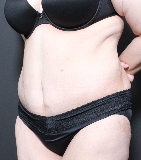 Plus sized tummy tuck patient