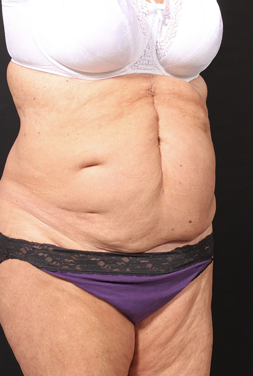 Plus sized tummy tuck patient