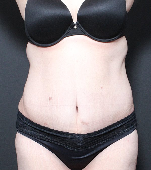 Plus sized tummy tuck patient