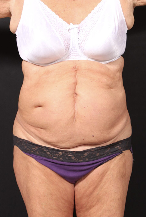 Plus sized tummy tuck patient