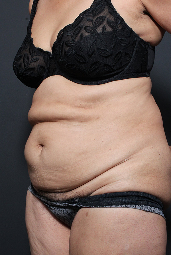 Plus sized tummy tuck patient