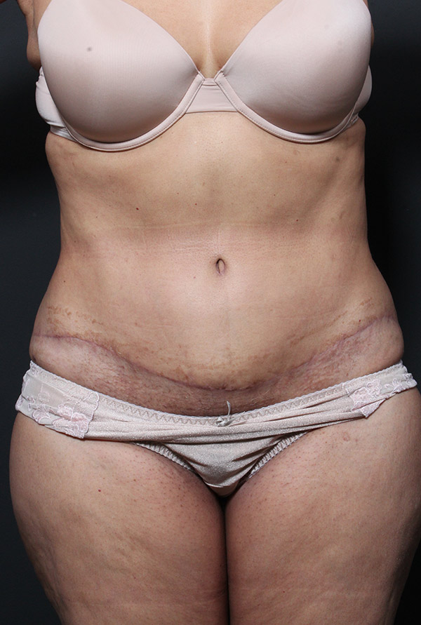 Plus sized tummy tuck patient