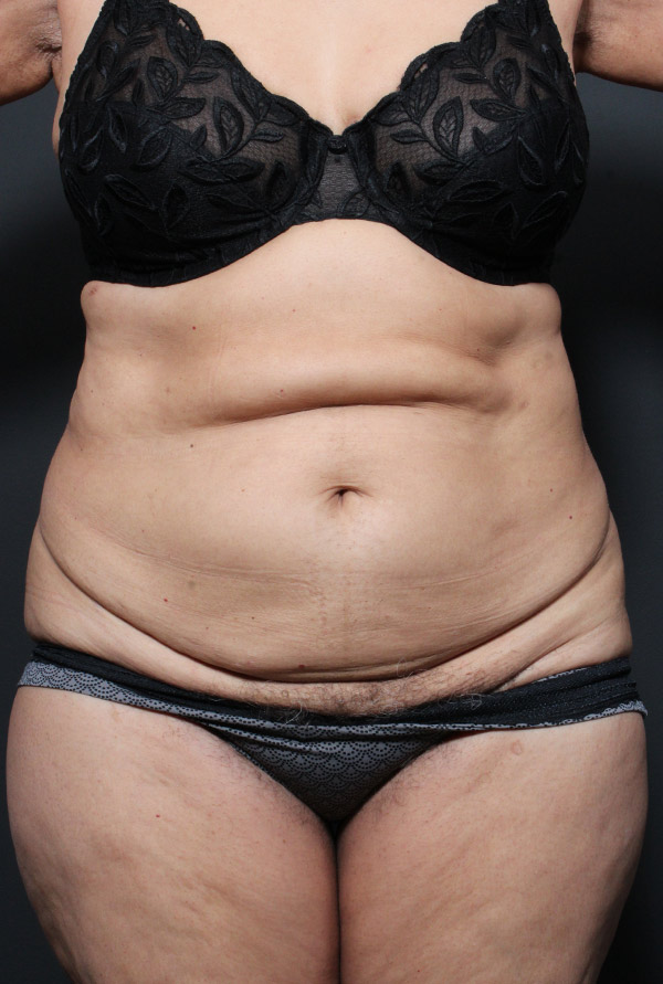 Plus sized tummy tuck patient