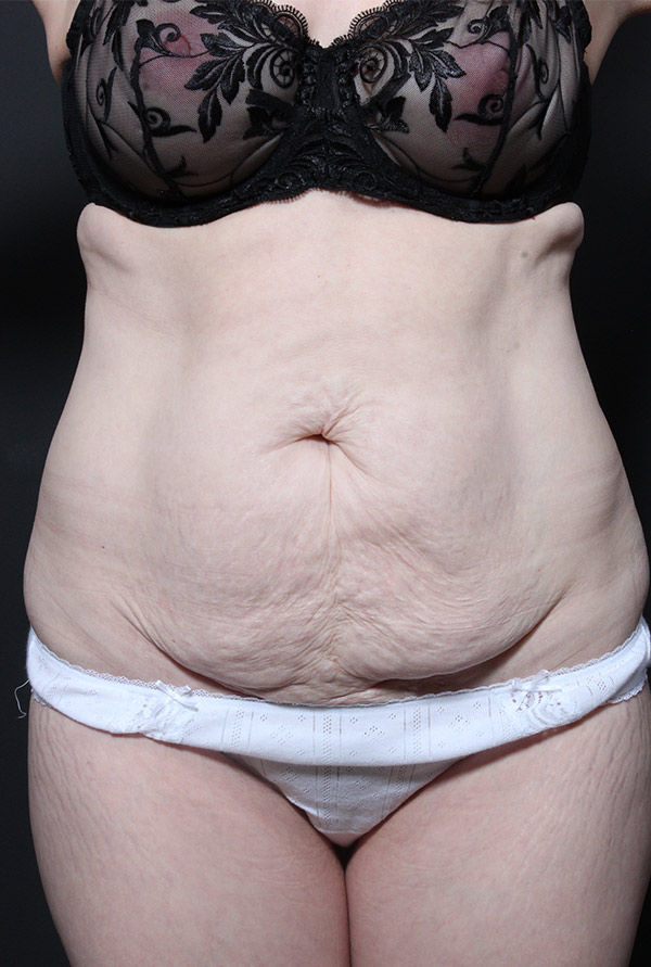 Plus sized tummy tuck patient