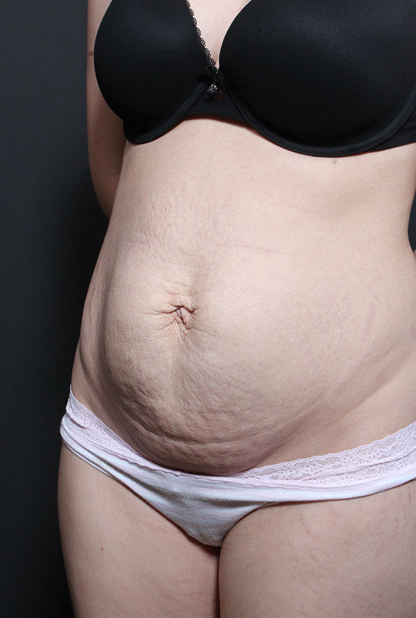 Plus sized tummy tuck patient