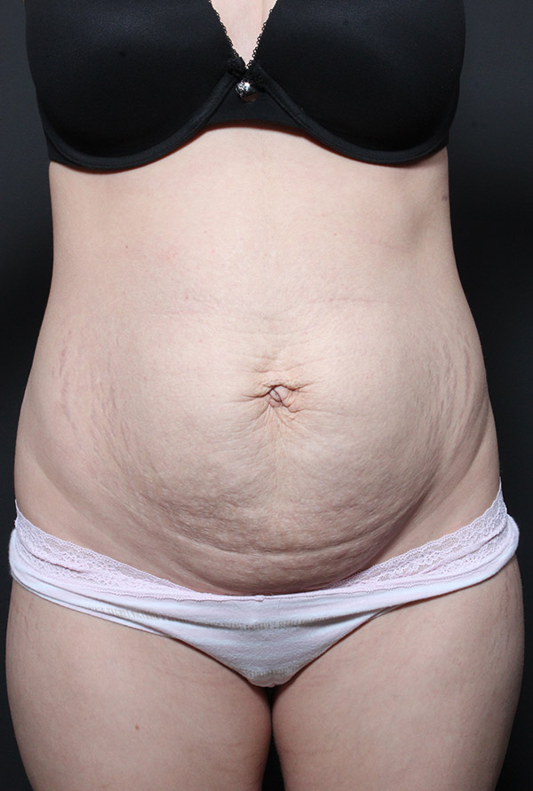 Plus sized tummy tuck patient