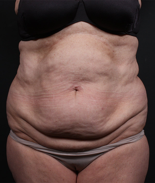 Plus sized tummy tuck patient