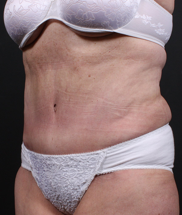 Plus sized tummy tuck patient