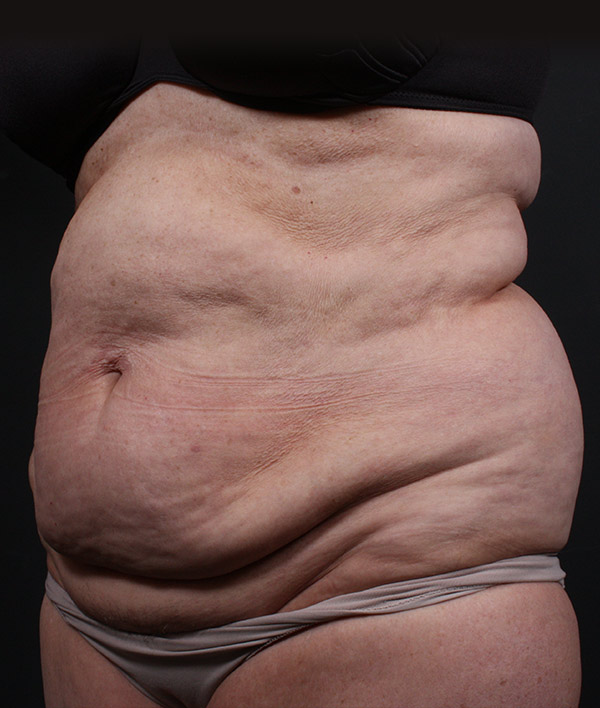 Plus sized tummy tuck patient