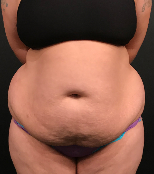 Plus sized tummy tuck patient