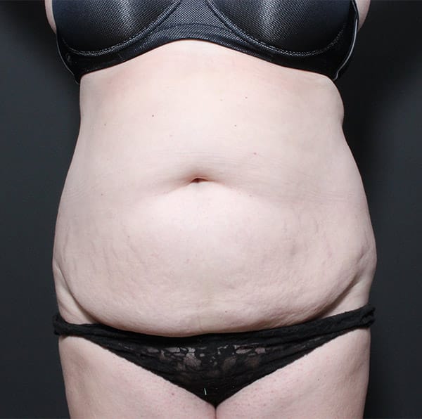 Tummy tuck patient