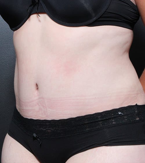 Tummy tuck patient