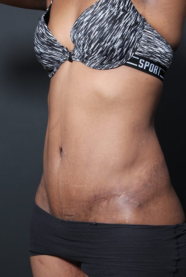 Tummy tuck patient