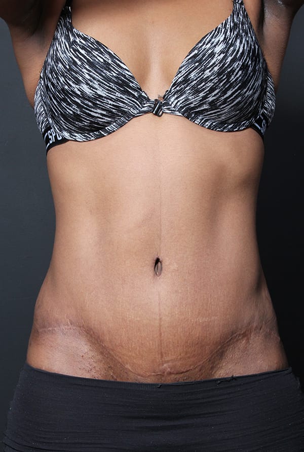 Tummy tuck patient