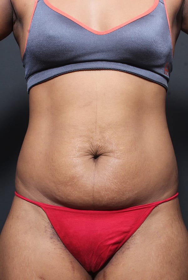 Tummy tuck patient