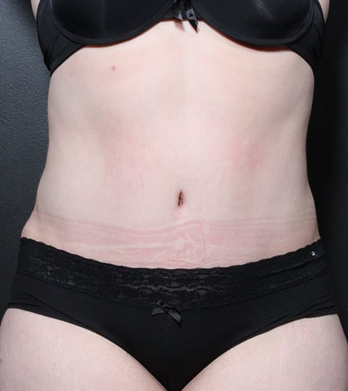 Tummy tuck patient