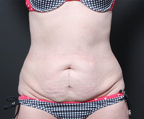 Tummy tuck patient