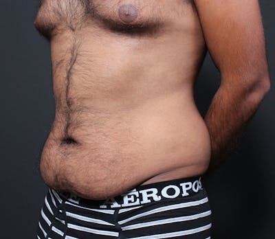 Male Tummy Tuck Before & After Gallery - Patient 391926 - Image 1