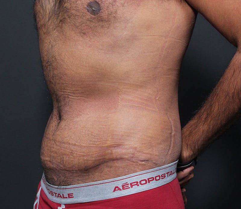 Male Tummy Tuck Before & After Gallery - Patient 391926 - Image 2