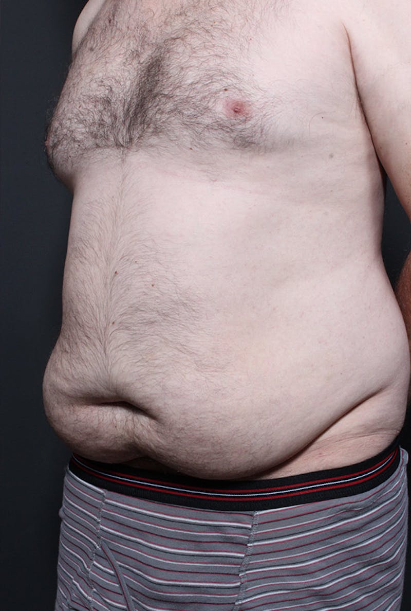 Male Tummy Tuck Before & After Gallery - Patient 179068 - Image 1