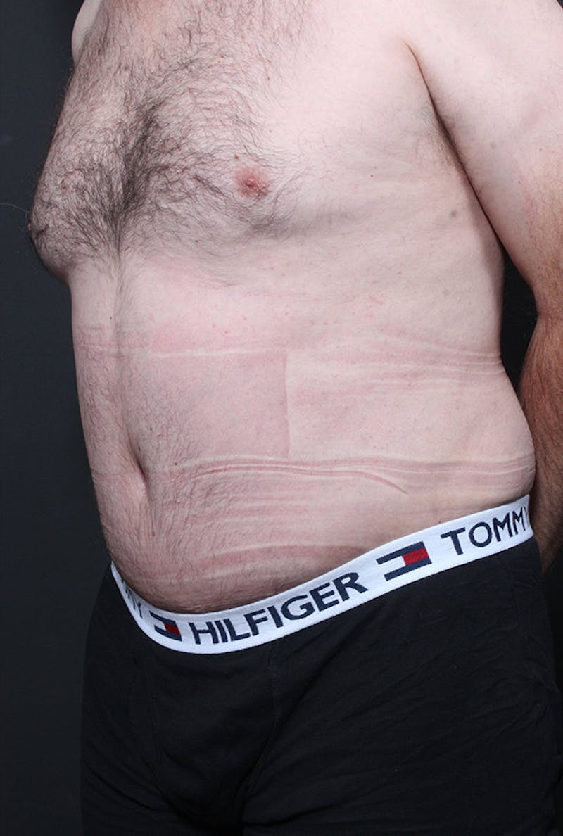 Male Tummy Tuck Before & After Gallery - Patient 179068 - Image 2