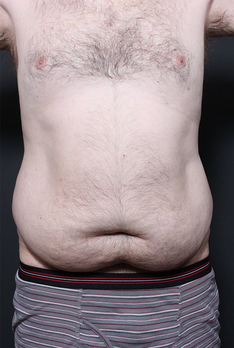 Male Tummy Tuck Before & After Gallery - Patient 179068 - Image 3