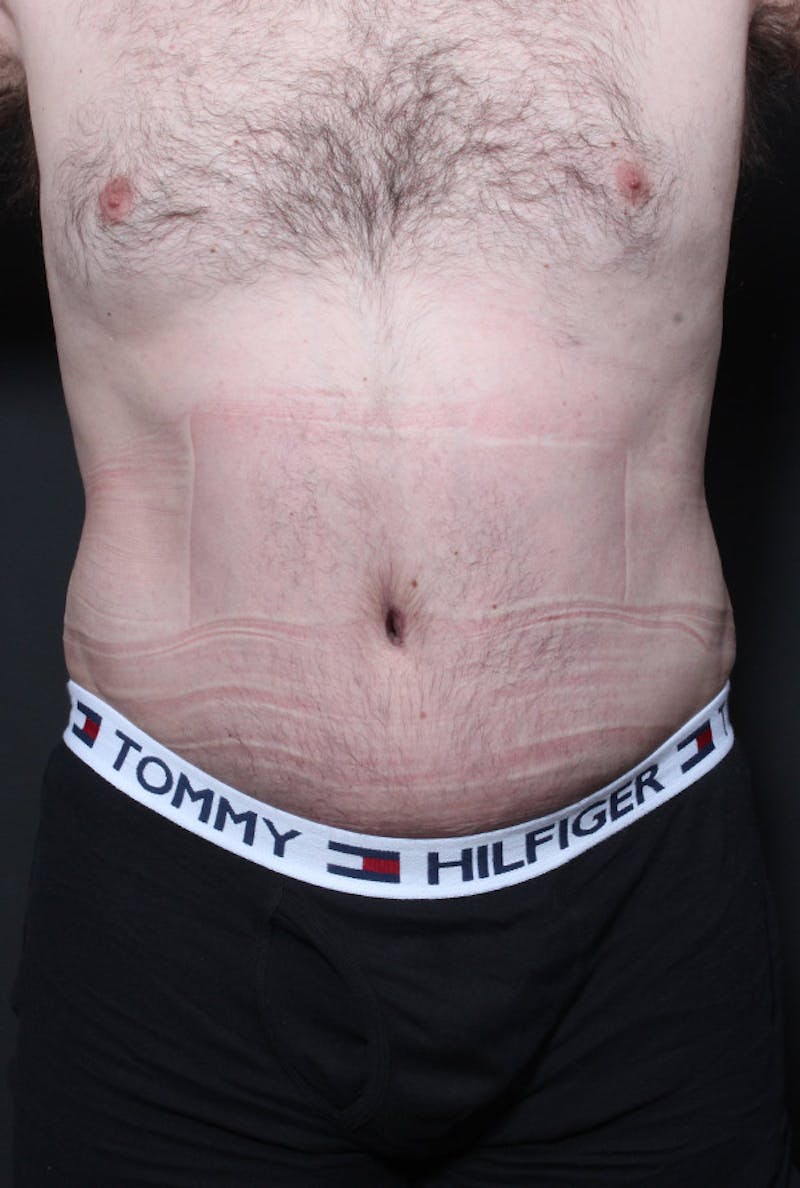 Male Tummy Tuck Before & After Gallery - Patient 179068 - Image 4
