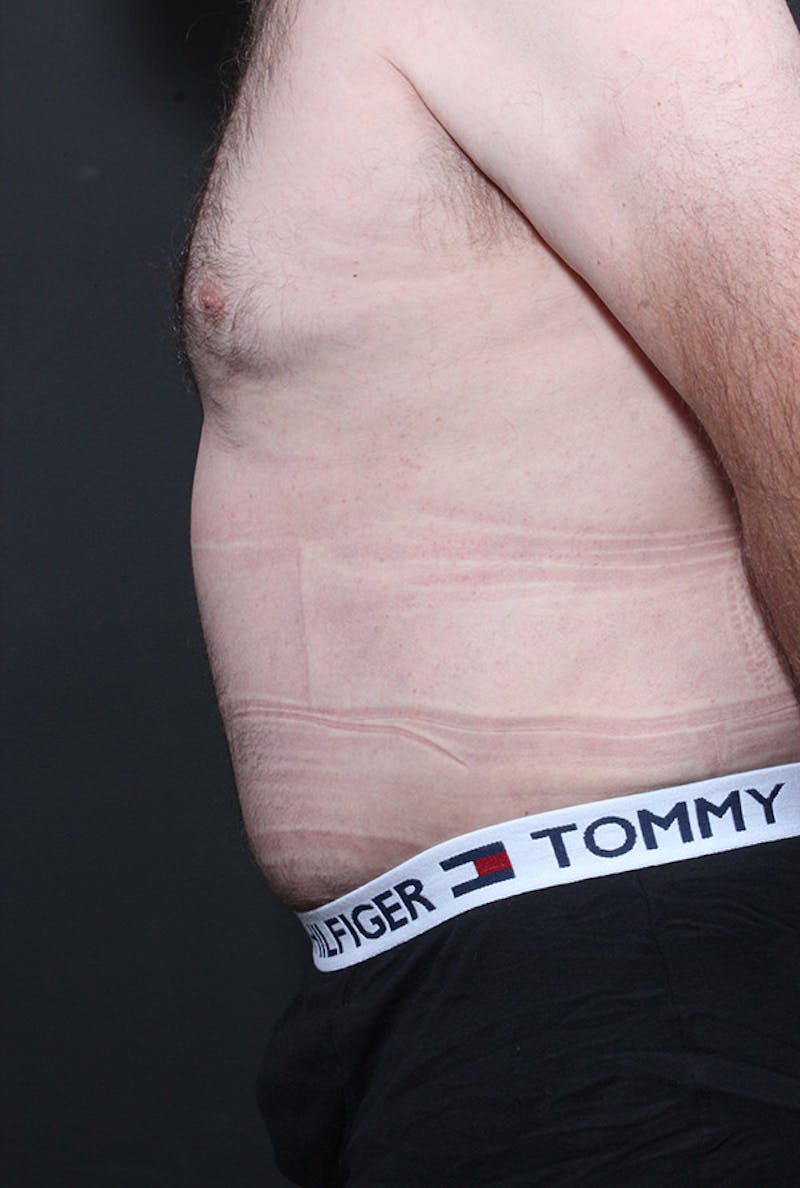 Male Tummy Tuck Before & After Gallery - Patient 179068 - Image 6