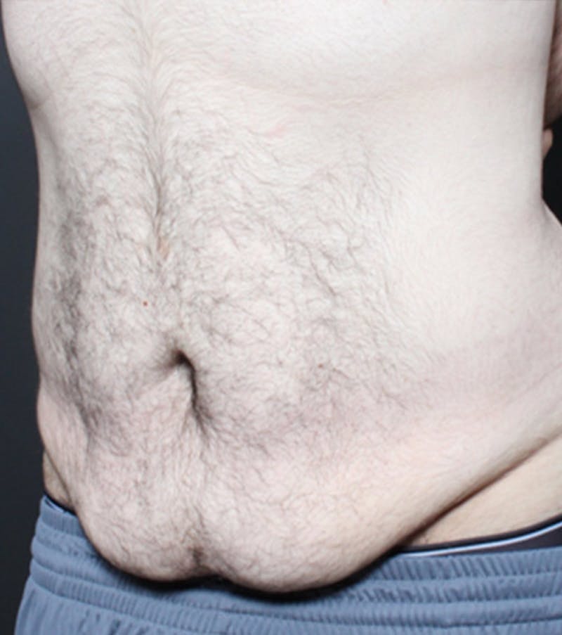 Male Tummy Tuck Before & After Gallery - Patient 722046 - Image 1