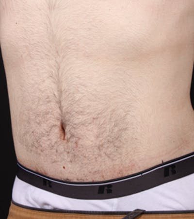 Male Tummy Tuck Before & After Gallery - Patient 722046 - Image 2